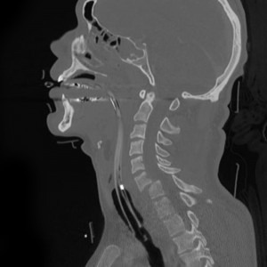 Whiplash From a Car Wreck