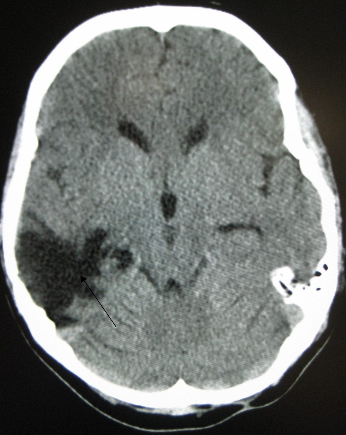 Traumatic Brain Injury Attorney