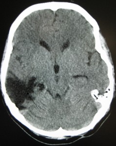 Traumatic Brain Injury Attorney