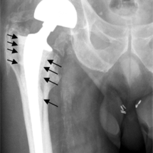 Hip Replacement Lawsuit Lawyer