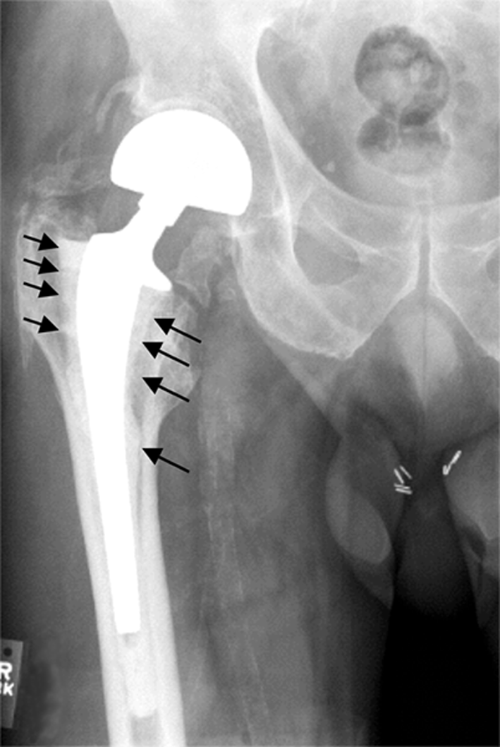 Hip Replacement Lawsuit Lawyer