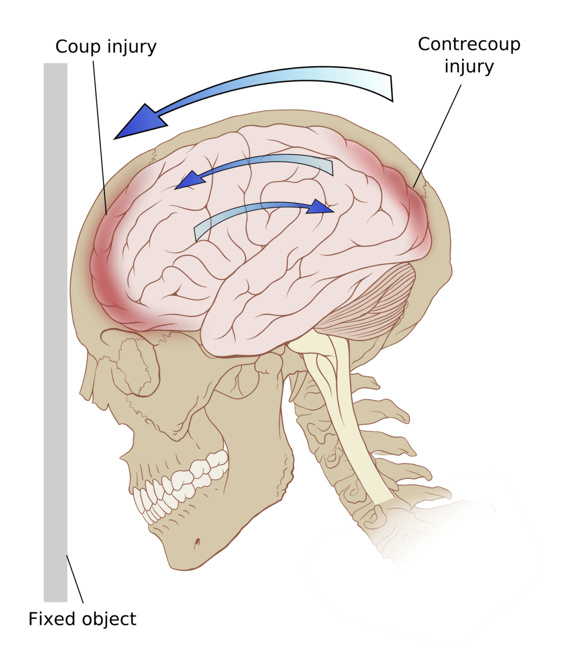 Choosing TBI Rehabilitation