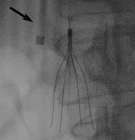 IVC Filter Lawyers in Dallas Texas