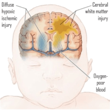 HIE Birth Injury Lawyer in Dallas