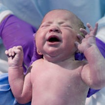 Texas Torticollis Birth Injury Lawyer