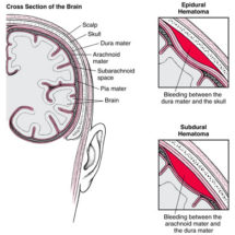 Subdural and Epidura Hematoma Lawyer