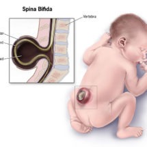 Spina Bifida Birth Defect Lawsuit