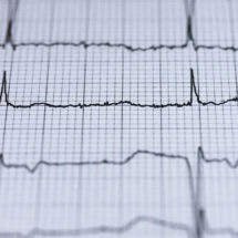 Fetal Bradycardia Birth Injuries