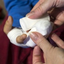 Injuries to the Fingers