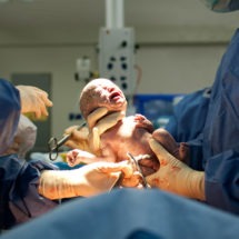 Birth Injury Caused by Delayed Delivery